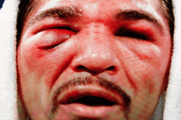 antonio-margarito-eye