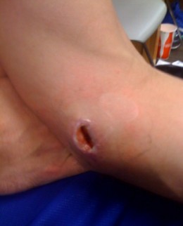 david-lee-elbow1