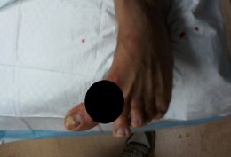 miguel-torres-toe-injury