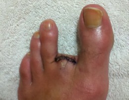 neil-melanson-toe1