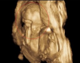 ultrasound-baby-tebowing