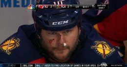 john-madden-bloody-nose