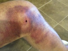 Sami-Lepisto-leg-bruise