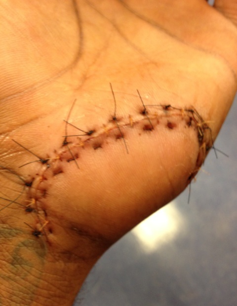 Amar'e Stoudemire shares picture of his hand full of ...