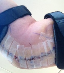 Todd-Coffey-Elbow-stitches