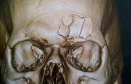 JP-Joubert-fractured-skull