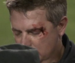 umpire-greg-gibson-eye-bleeding
