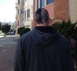 brandon-mccarthy-brain-surgery-scar