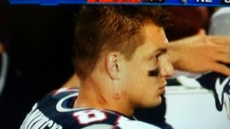 rob-gronkowski-hickeys