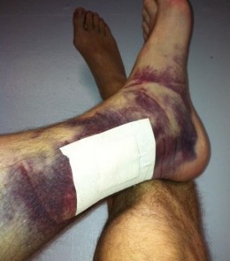 Chipper-Jones-leg-bruise