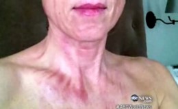 hannah-storm-injuries-1