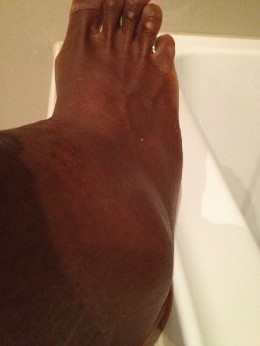 serena-williams-ankle