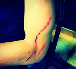 stephen-curry-arm-scratches