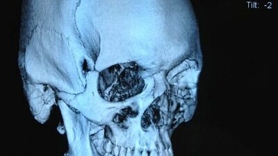 Stefan Struve X-ray