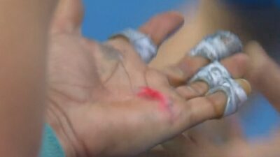 Rafael Nadal blisters
