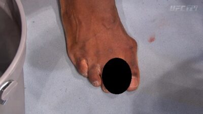 Uriah Hall toe censored