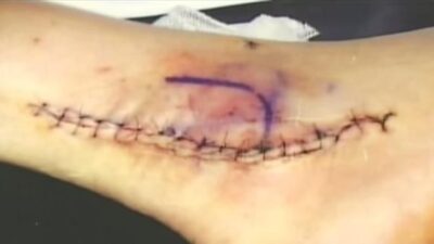 Curt Schilling bloody ankle