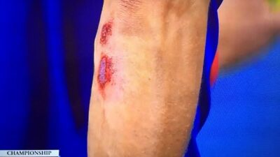 Novak Djokovic bloody elbow