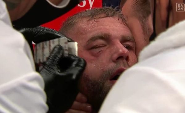 Billy Joe Saunders eye