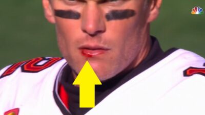 Tom Brady has a bloody lip