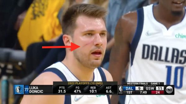 Luka Doncic with a scratch on his face