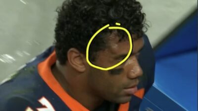Russell Wilson with a knot on his head
