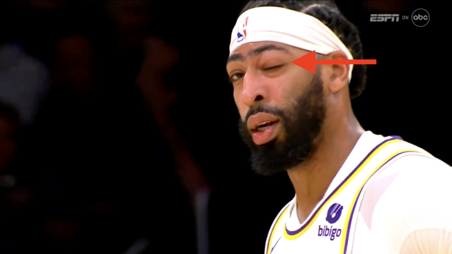Anthony Davis shares nasty details of his eye injury