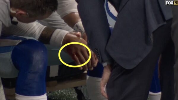 Dak Prescott bleeding from the hand