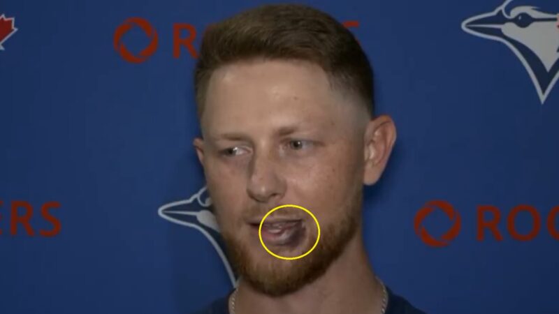 Eric Lauer with a fat lip