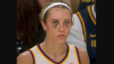 Lexie Hull with two black eyes