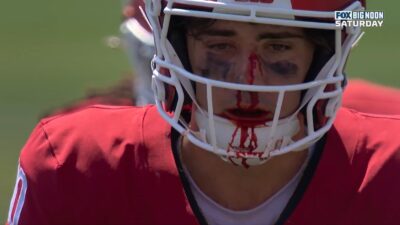 Josh Hoover with blood on his face