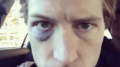 Shaun White black eye