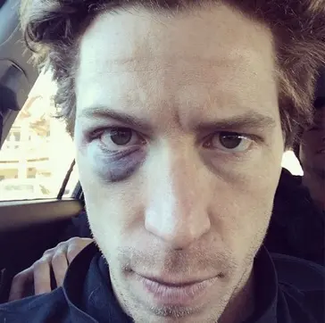 Shaun White black eye
