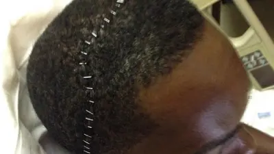 Aroldis Chapman staples head