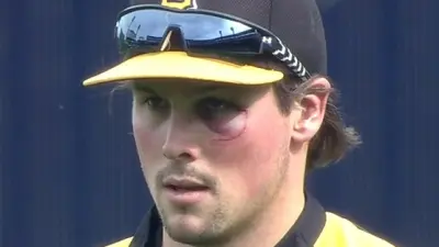 Travis Snider black eye Pirates