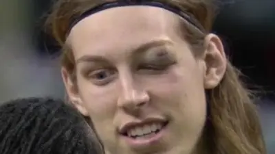 Kelly Olynyk eye