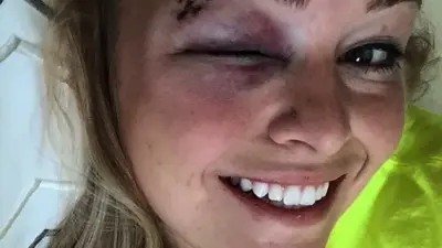 Paige Lowary eye