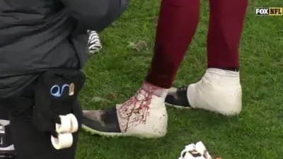 Alex Smith bloody leg