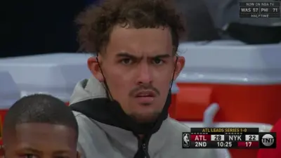 Trey Young is balding
