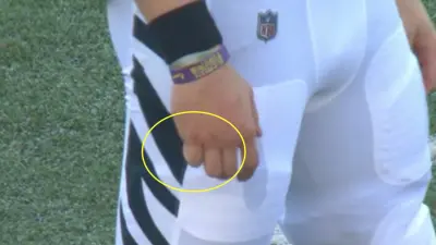 Joe Burrow had a swollen finger