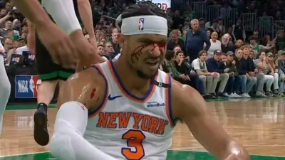 Josh Hart with blood on his face